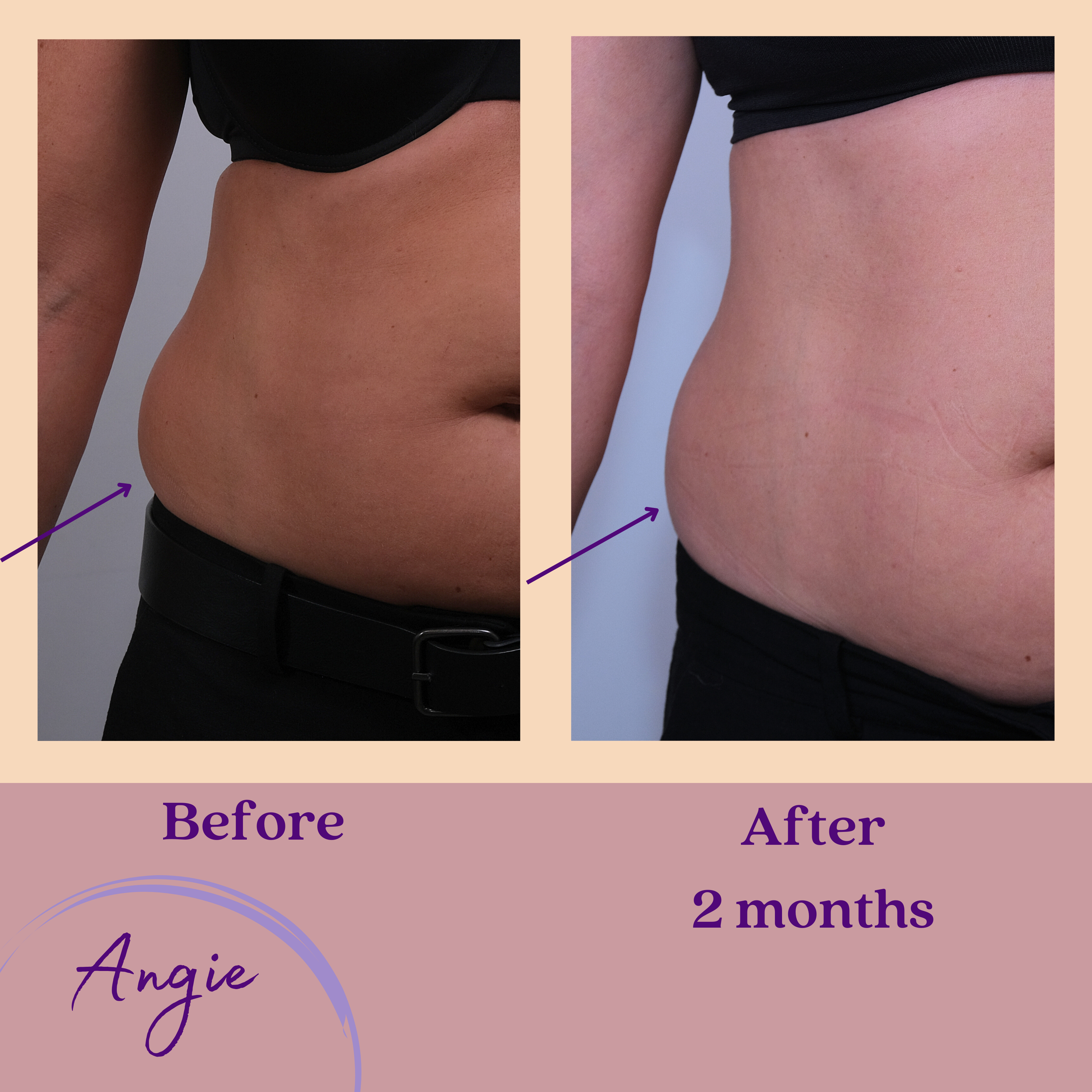 Angie's waist results: Before and after 2 months using One Truth 818 anti ageing Body Cream skincare routine with TAM-818.