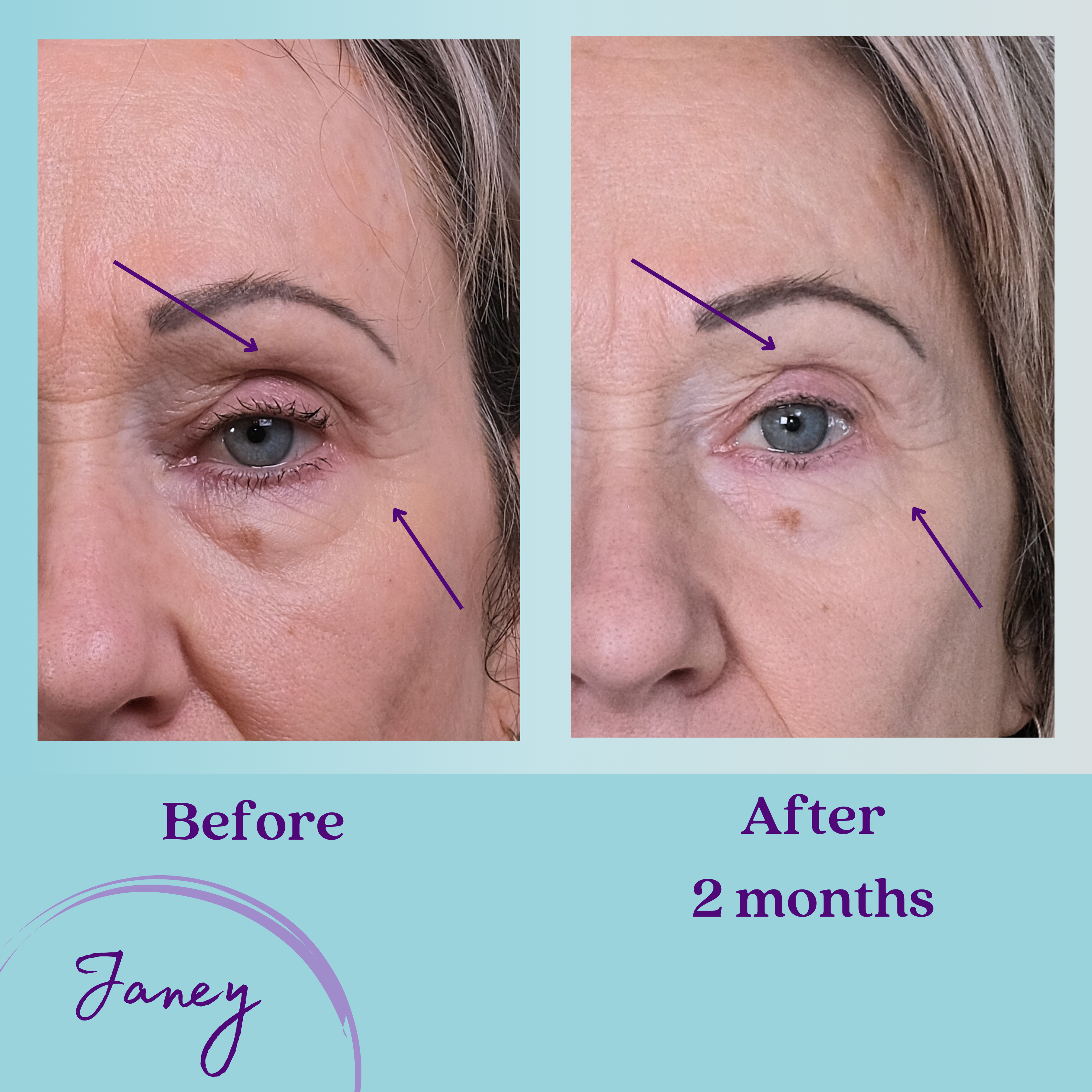 Janey's eye results: Before and after 2 months using One Truth 818 anti ageing Serum skincare routine with TAM-818.